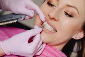Composiet facings behandeling bij Aesthetic Beauty Center